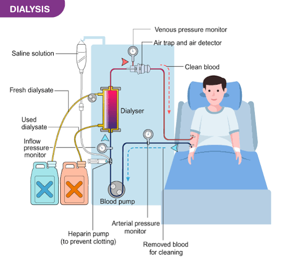 types-of-vascular-access-for-dialysis